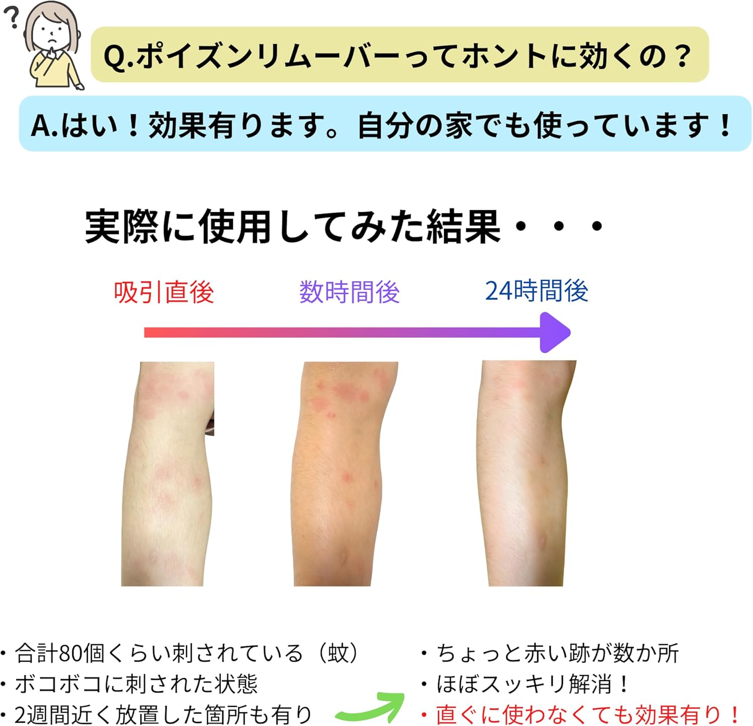強力型ポイズンリムーバー｜虫刺され（ハチ・ブヨ・ヤマビル）毒吸引器
