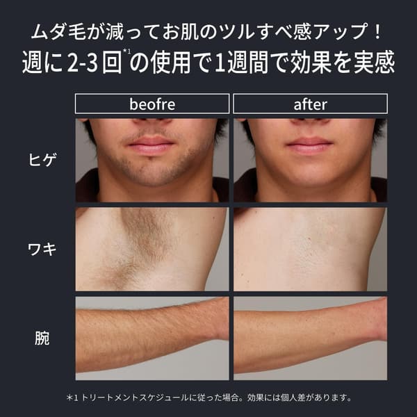 メンズ用家庭用脱毛器 サロン級 VIO対応 痛みレス 高出力 ブラック